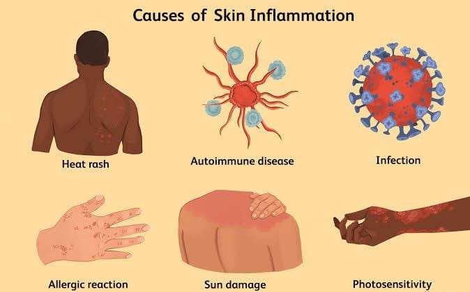 Understanding Inflammation: Causes, Management, and the Role of Physiotherapy